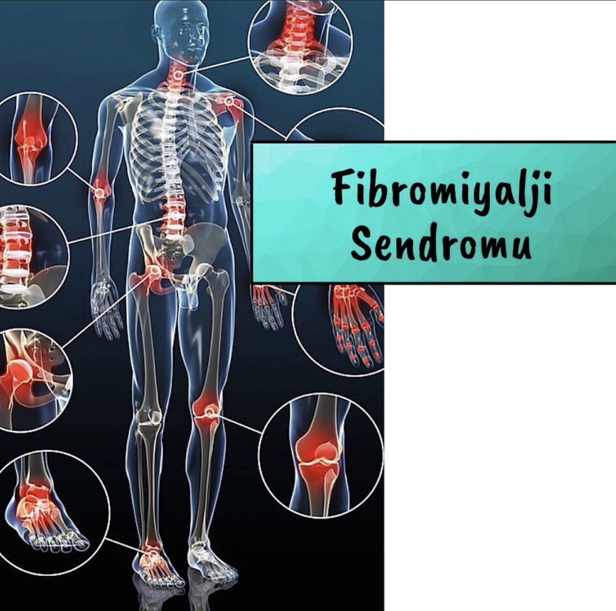 Fibromiyalji Sendromu